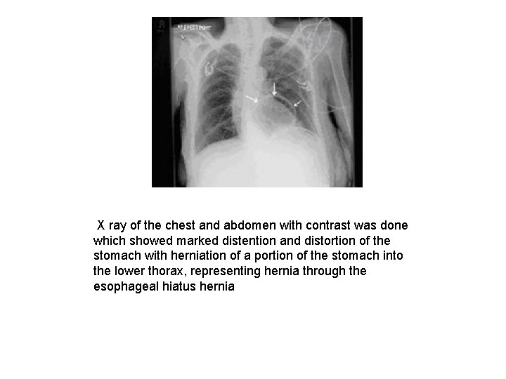  X ray of the chest and abdomen with contrast was done which showed