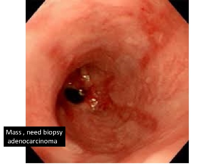 Mass , need biopsy adenocarcinoma 