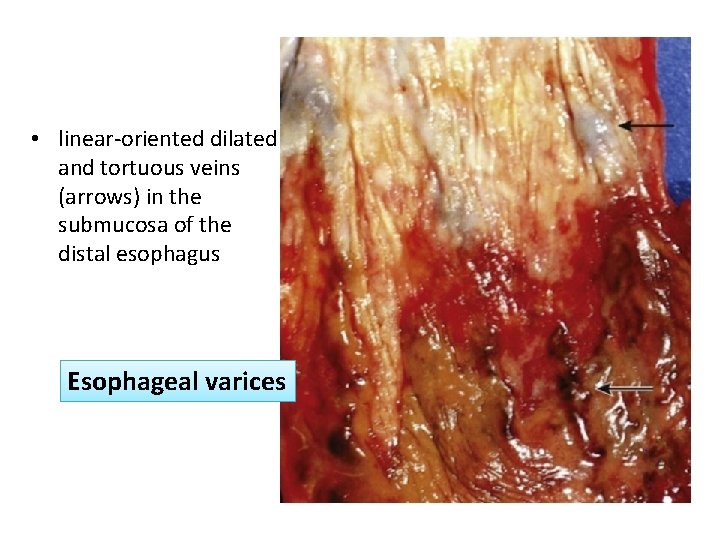  • linear-oriented dilated and tortuous veins (arrows) in the submucosa of the distal