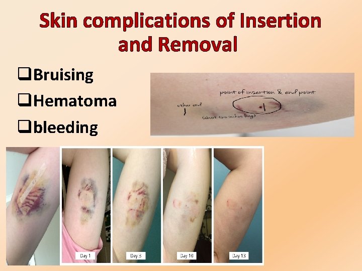  Skin complications of Insertion and Removal q. Bruising q. Hematoma qbleeding 