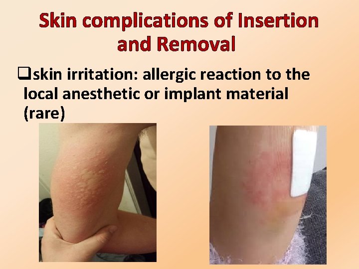  Skin complications of Insertion and Removal qskin irritation: allergic reaction to the local