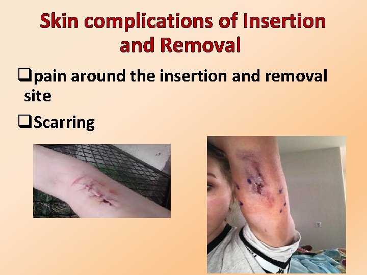  Skin complications of Insertion and Removal qpain around the insertion and removal site