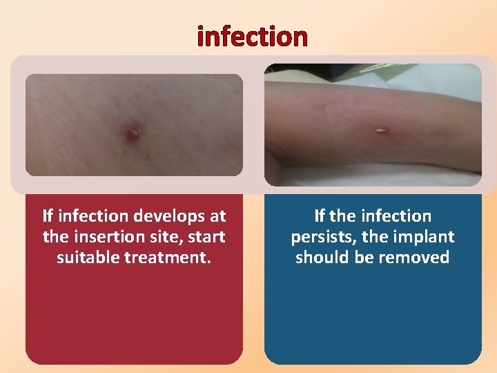 infection If infection develops at the insertion site, start suitable treatment. If the infection