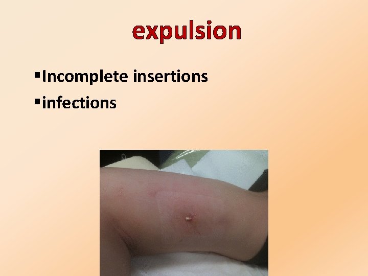 expulsion §Incomplete insertions §infections 