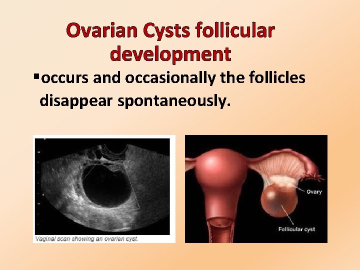 Ovarian Cysts follicular development §occurs and occasionally the follicles disappear spontaneously. 