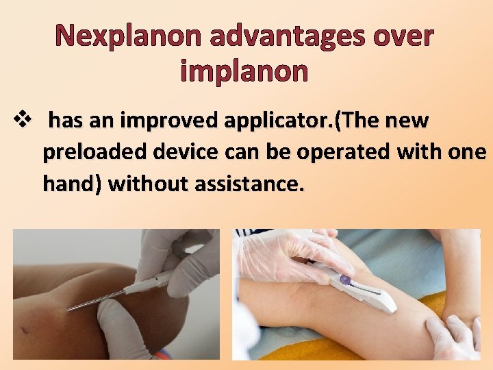 Nexplanon advantages over implanon v has an improved applicator. (The new preloaded device can