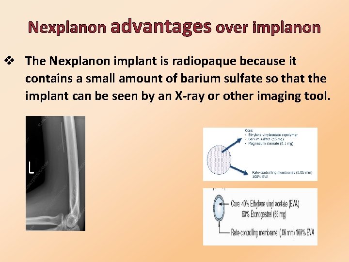  Nexplanon advantages over implanon v The Nexplanon implant is radiopaque because it contains