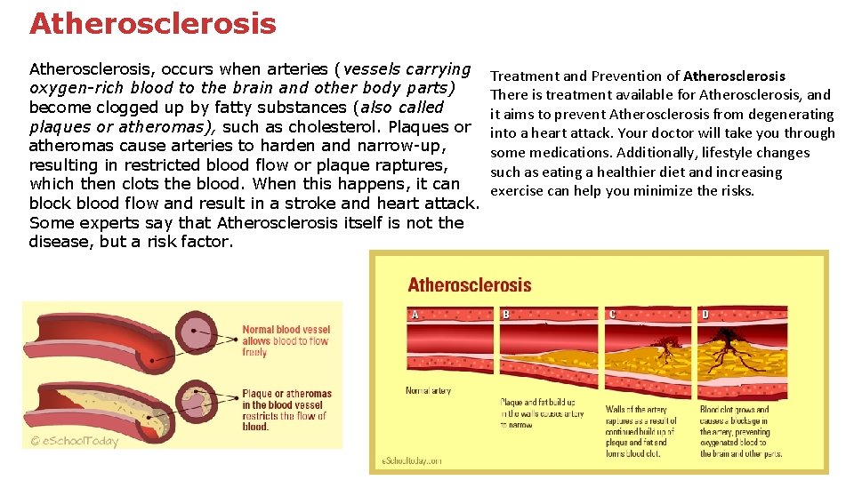 Atherosclerosis, occurs when arteries (vessels carrying oxygen-rich blood to the brain and other body