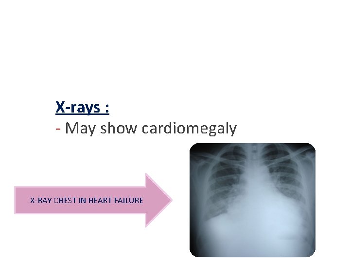 X-rays : - May show cardiomegaly X-RAY CHEST IN HEART FAILURE 