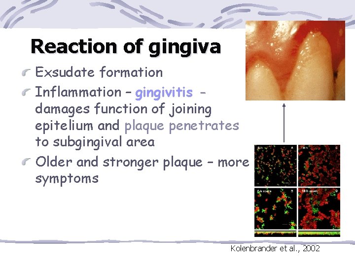 Reaction of gingiva Exsudate formation Inflammation – gingivitis damages function of joining epitelium and