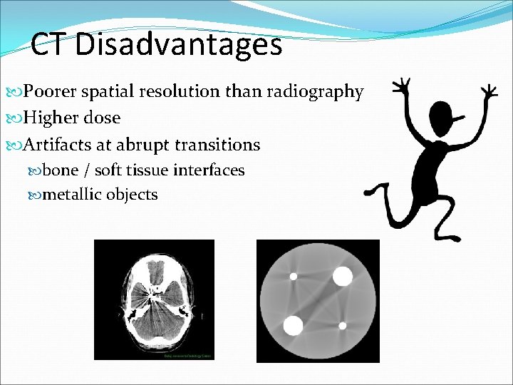 CT Disadvantages Poorer spatial resolution than radiography Higher dose Artifacts at abrupt transitions bone