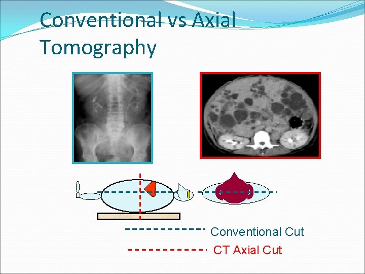 Conventional vs Axial Tomography Conventional Cut CT Axial Cut 