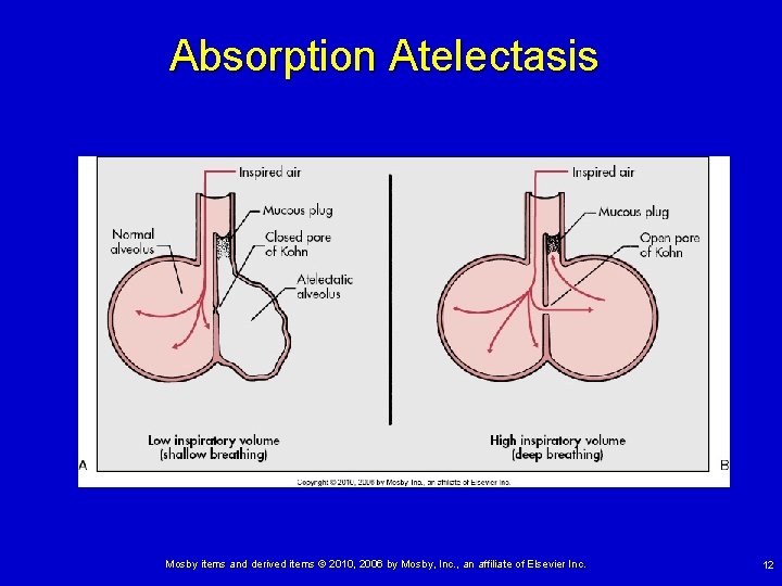 Absorption Atelectasis Mosby items and derived items © 2010, 2006 by Mosby, Inc. , Absorption Atelectasis Mosby items and derived items © 2010, 2006 by Mosby, Inc. ,