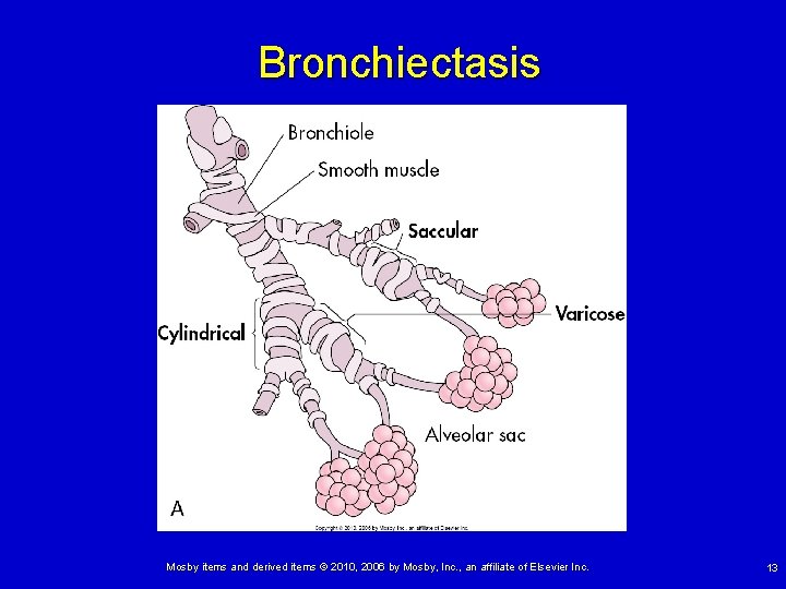 Bronchiectasis Mosby items and derived items © 2010, 2006 by Mosby, Inc. , an