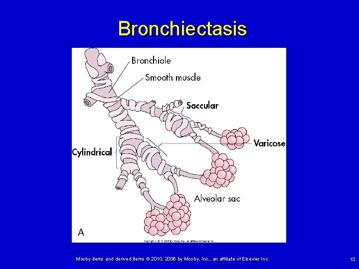 Bronchiectasis Mosby items and derived items © 2010, 2006 by Mosby, Inc. , an Bronchiectasis Mosby items and derived items © 2010, 2006 by Mosby, Inc. , an