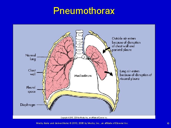 Pneumothorax Mosby items and derived items © 2010, 2006 by Mosby, Inc. , an