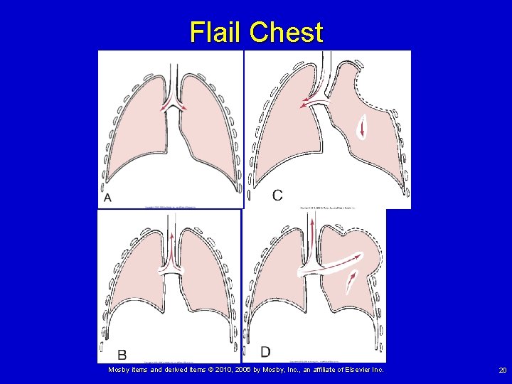 Flail Chest Mosby items and derived items © 2010, 2006 by Mosby, Inc. , Flail Chest Mosby items and derived items © 2010, 2006 by Mosby, Inc. ,