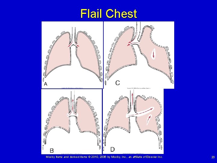 Flail Chest Mosby items and derived items © 2010, 2006 by Mosby, Inc. ,