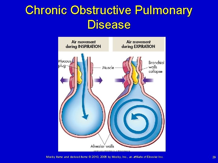 Chronic Obstructive Pulmonary Disease Mosby items and derived items © 2010, 2006 by Mosby,