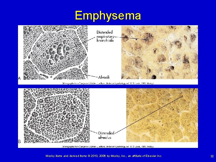 Emphysema Mosby items and derived items © 2010, 2006 by Mosby, Inc. , an