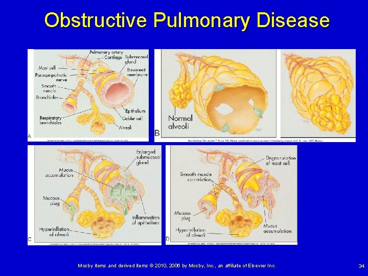 Obstructive Pulmonary Disease Mosby items and derived items © 2010, 2006 by Mosby, Inc. Obstructive Pulmonary Disease Mosby items and derived items © 2010, 2006 by Mosby, Inc.