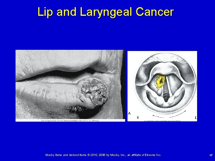Lip and Laryngeal Cancer Mosby items and derived items © 2010, 2006 by Mosby, Lip and Laryngeal Cancer Mosby items and derived items © 2010, 2006 by Mosby,