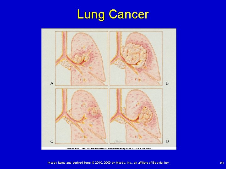 Lung Cancer Mosby items and derived items © 2010, 2006 by Mosby, Inc. ,