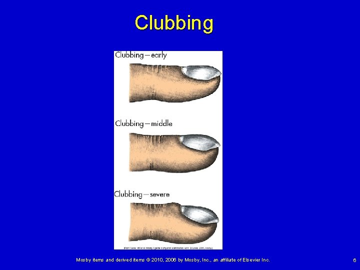 Clubbing Mosby items and derived items © 2010, 2006 by Mosby, Inc. , an