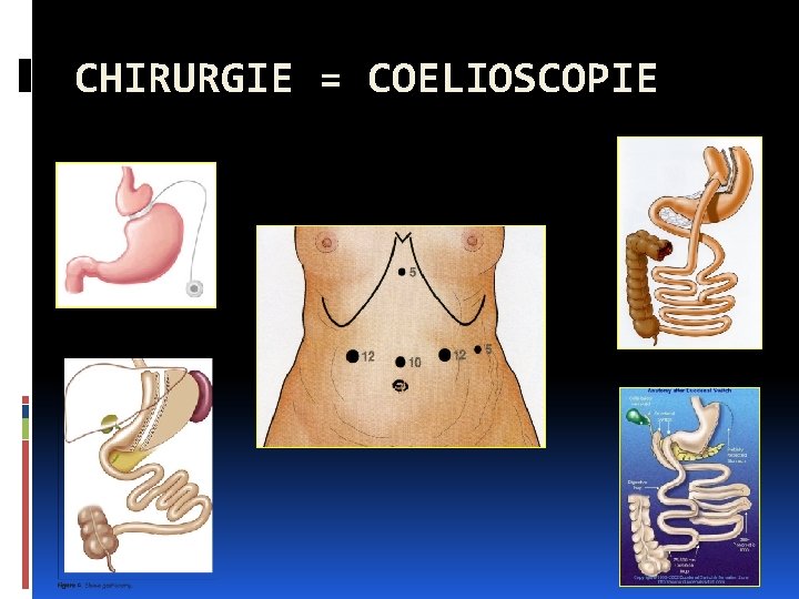 CHIRURGIE = COELIOSCOPIE 