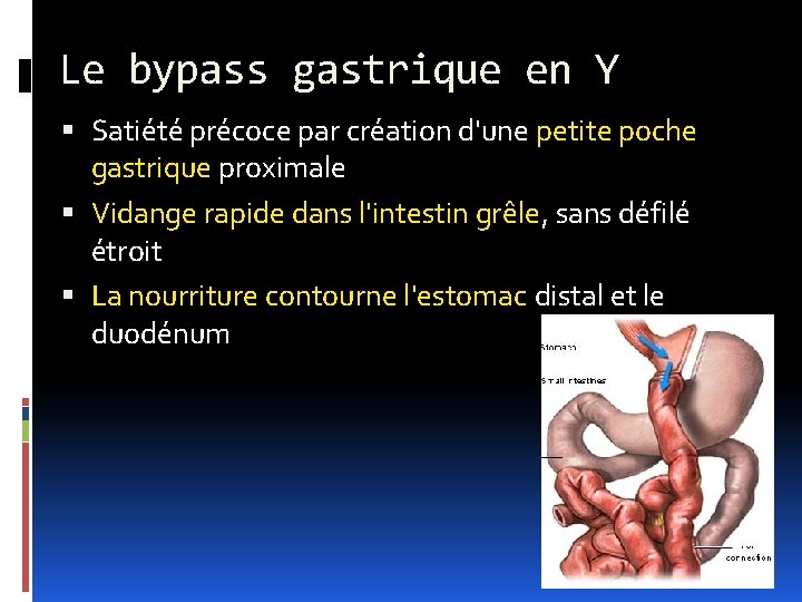 Le bypass gastrique en Y Satiété précoce par création d'une petite poche gastrique proximale