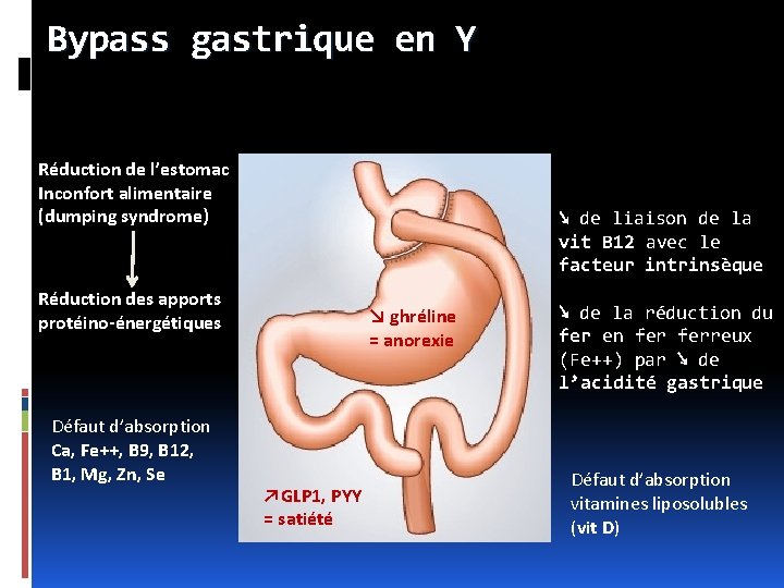 Bypass gastrique en Y Réduction de l’estomac Inconfort alimentaire (dumping syndrome) ↘ de liaison