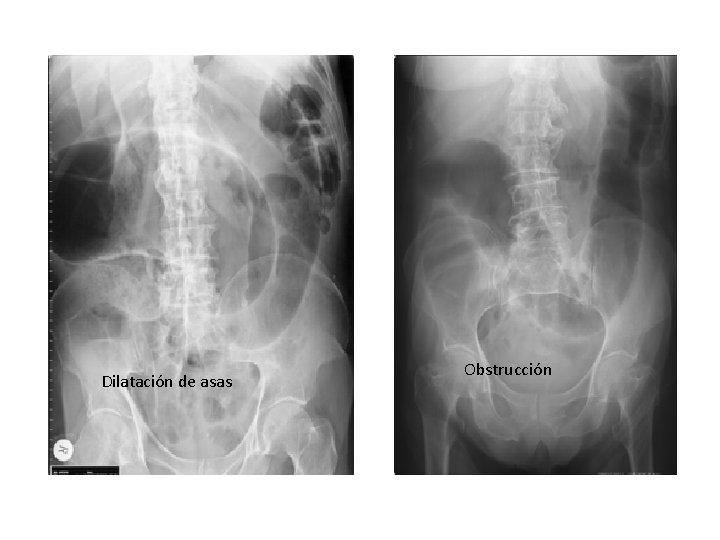 Dilatación de asas Obstrucción 