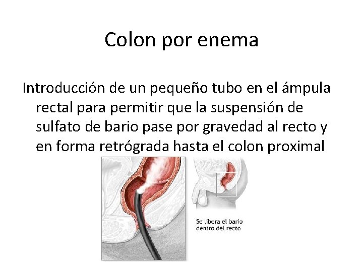 Colon por enema Introducción de un pequeño tubo en el ámpula rectal para permitir