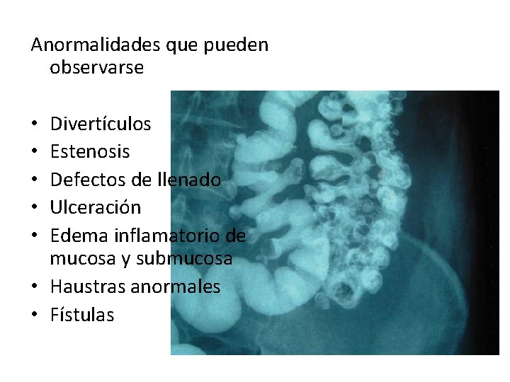 Anormalidades que pueden observarse Divertículos Estenosis Defectos de llenado Ulceración Edema inflamatorio de mucosa