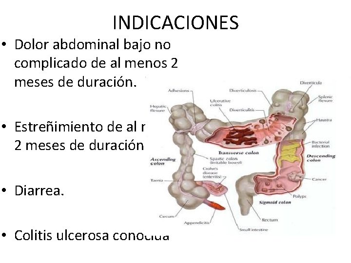 INDICACIONES • Dolor abdominal bajo no complicado de al menos 2 meses de duración.