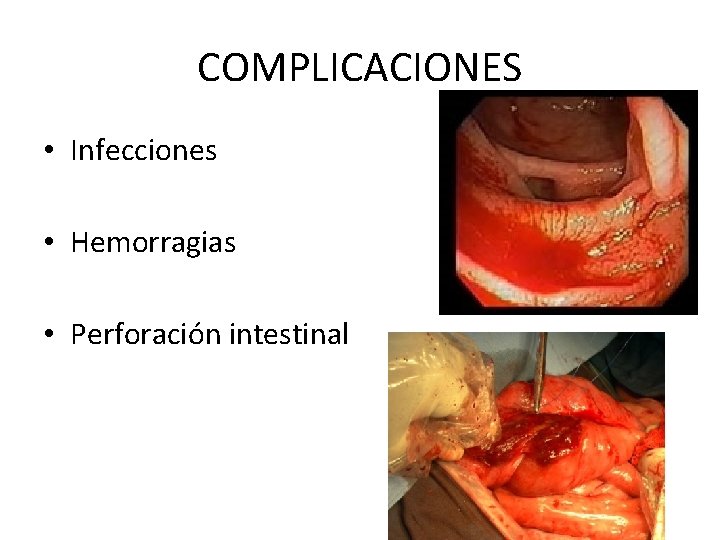 COMPLICACIONES • Infecciones • Hemorragias • Perforación intestinal 