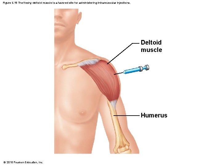 Figure 6. 19 The fleshy deltoid muscle is a favored site for administering intramuscular