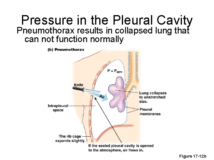 Pressure in the Pleural Cavity Pneumothorax results in collapsed lung that can not function