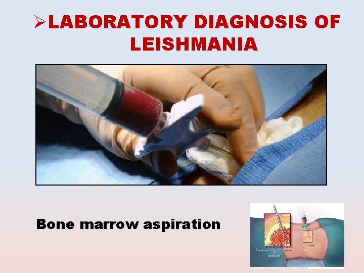 ØLABORATORY DIAGNOSIS OF LEISHMANIA Bone marrow aspiration 