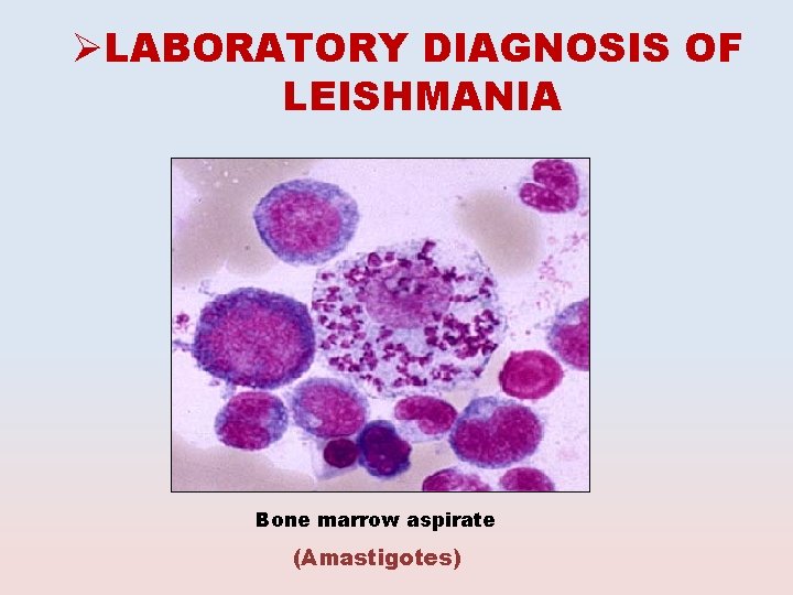 ØLABORATORY DIAGNOSIS OF LEISHMANIA Bone marrow aspirate (Amastigotes) 