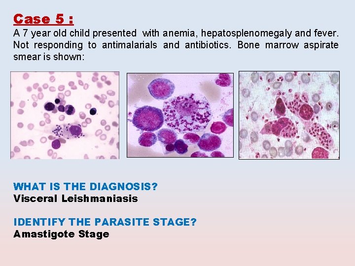 Case 5 : A 7 year old child presented with anemia, hepatosplenomegaly and fever.