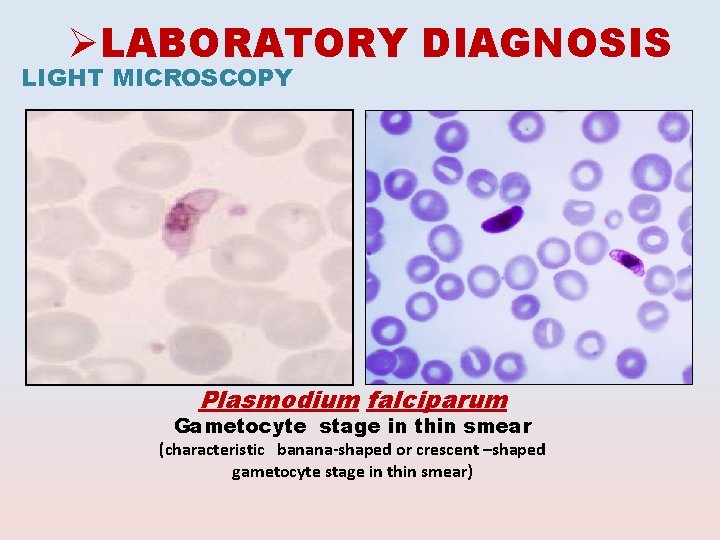 ØLABORATORY DIAGNOSIS LIGHT MICROSCOPY Plasmodium falciparum Gametocyte stage in thin smear (characteristic banana-shaped or