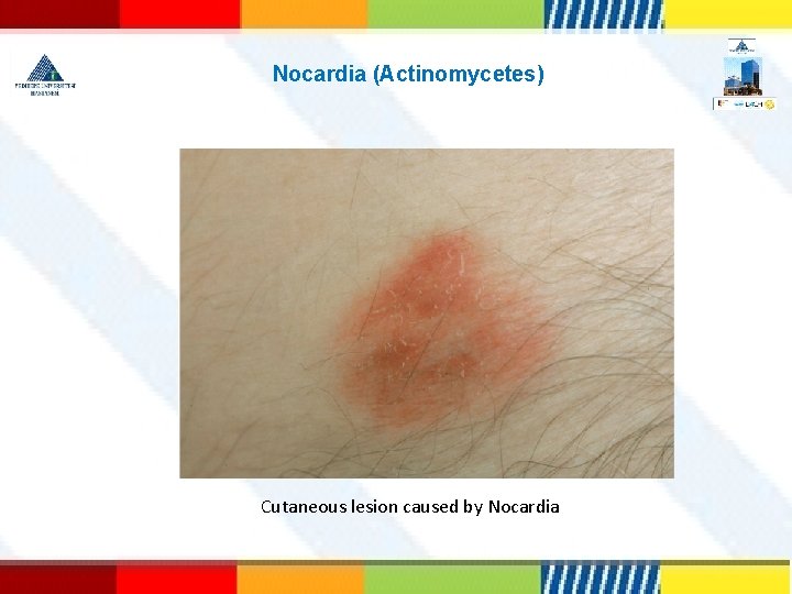  Nocardia (Actinomycetes) Cutaneous lesion caused by Nocardia 