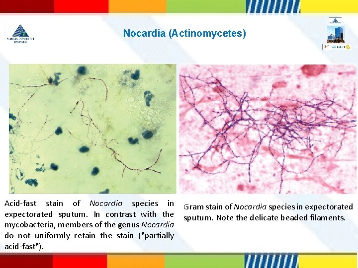  Nocardia (Actinomycetes) Acid-fast stain of Nocardia species in expectorated sputum. In contrast with