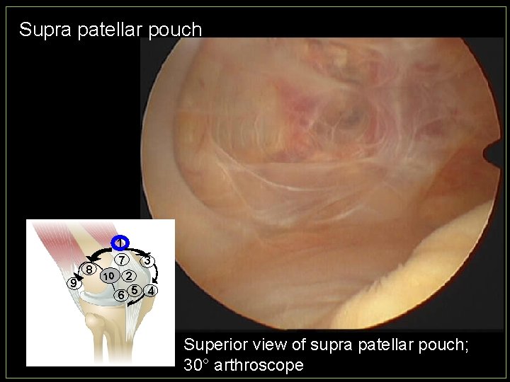 Supra patellar pouch 1 8 9 7 10 3 2 6 5 4 Superior