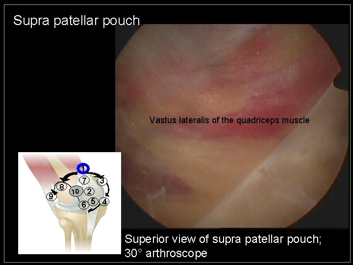Supra patellar pouch Vastus lateralis of the quadriceps muscle 1 8 9 7 10