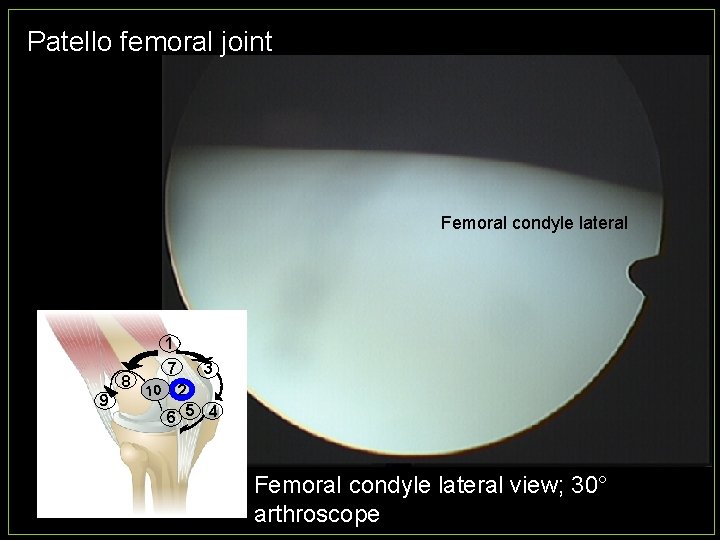 Patello femoral joint Femoral condyle lateral 1 8 9 7 10 3 2 6