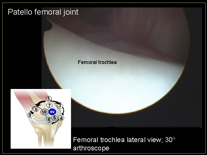 Patello femoral joint Femoral trochlea 1 8 9 7 10 3 2 6 5