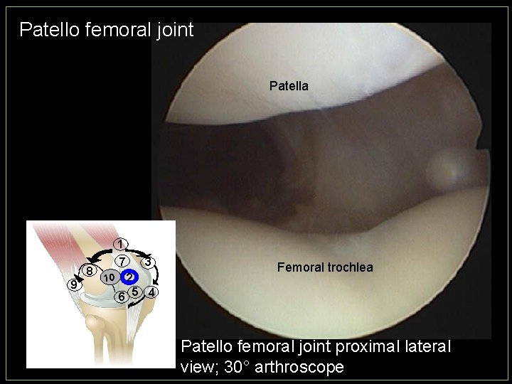 Patello femoral joint Patella 1 8 9 7 10 3 2 6 5 4