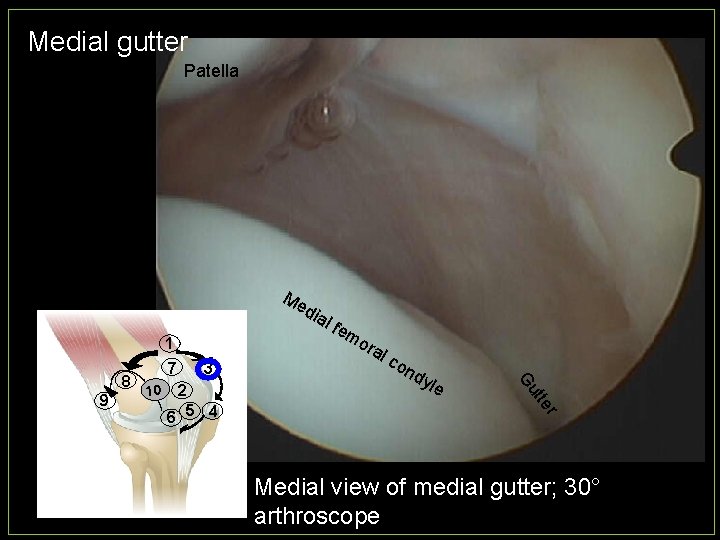 Medial gutter Patella Me dia l fe mo 1 9 10 3 dy le